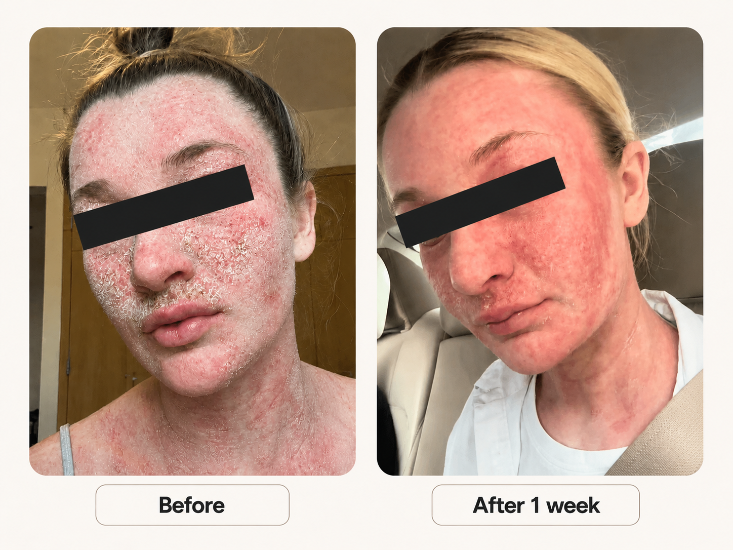 I Stopped Wearing Short Sleeves Because Of My Psoriasis. Here's What Happened After I Found in A Trip to Japan