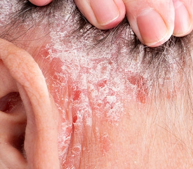 Psoriasis – The Ultimate Guide: Symptoms, Treatments, and Expert Advice