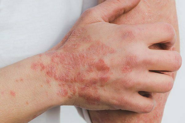 Psoriasis or Eczema Flare-Up? 6 Ways to Calm Irritated Skin Naturally