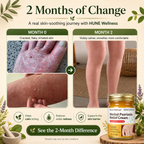 Herbal Psoriasis & Eczema Relief Skin Cream