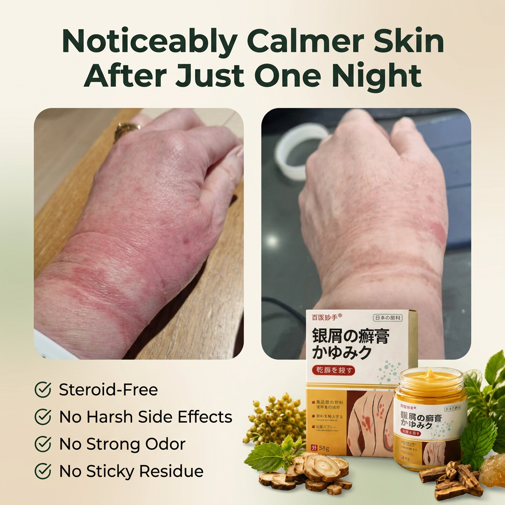 Herbal Psoriasis Relief Cream